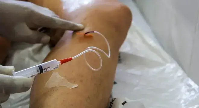 Crato realiza agendamento para mutirão de cirurgias de varizes